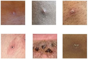 pictures of monkeypox infections